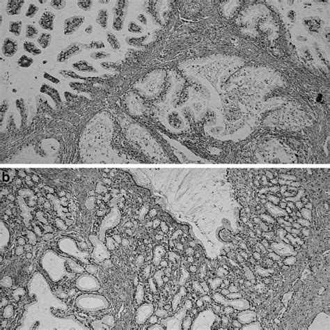 Legh With Atypical Features Atypical Legh With Cystic Spaces