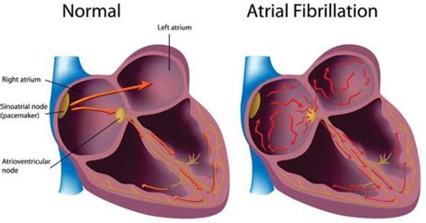 Caffeine Tobacco Or Alcohol In Excess Can Cause Atrial Fibrillation