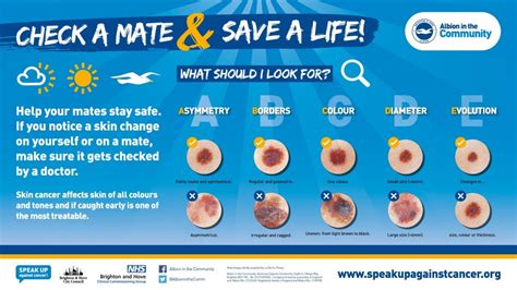 Mole Check Check A Mate Campaign Sussex Interpreting Services