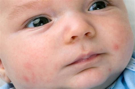 Why Baby Has Red Spots On Face Printable Templates Protal