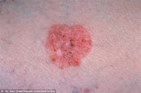 Squamous Cell Skin Carcinoma Pictures Pictures Photos
