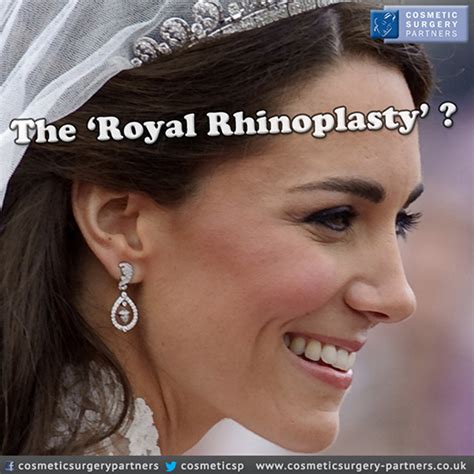 ‘royal Rhinoplasty Kate Middletons Nose The Latest Trend Cosmetic Surgery