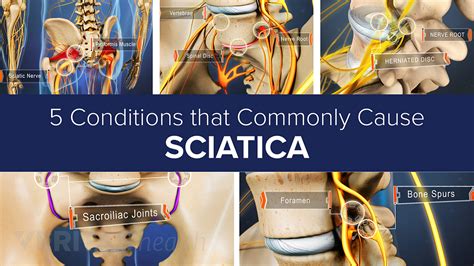 Sciatica Causes Spine Health