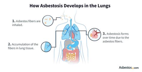 Asbestosis Discover Causes Symptoms Treatment And More