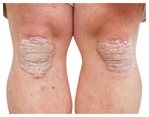What Does Psoriasis Look Like