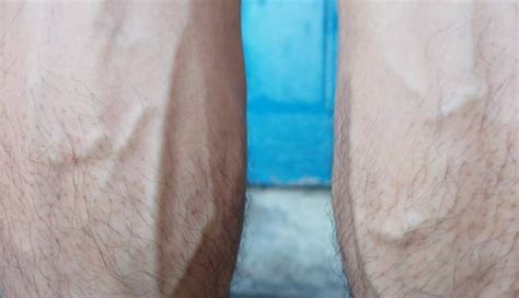 Are Your Bulging Veins A Cause For Concern Bulging Veins Vein