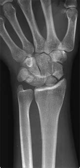 Lunate And Perilunate Dislocations Wikiradiography