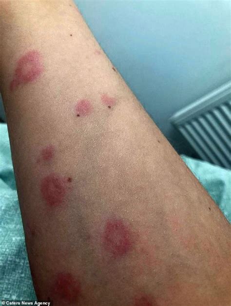 Woman 21 Is Branded Contagious For Her Skin Condition That Causes