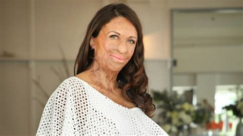Turia Pitt On Grassfire Recovery I Definitely Felt Like Tapping Out