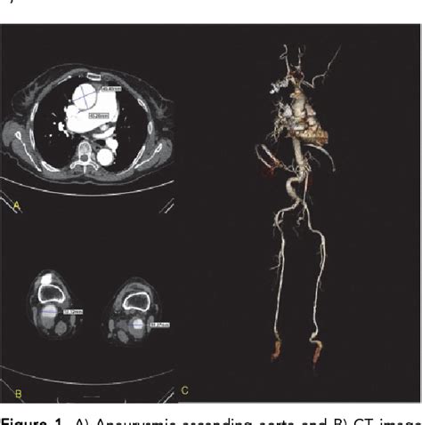 Figure 1 From The Case Of A Patient With Concomitant Popliteal Artery