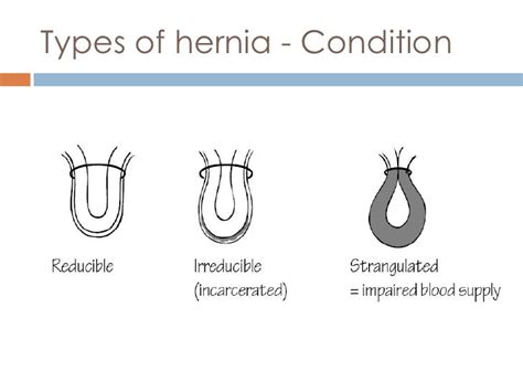Different Types Hernia Surgery