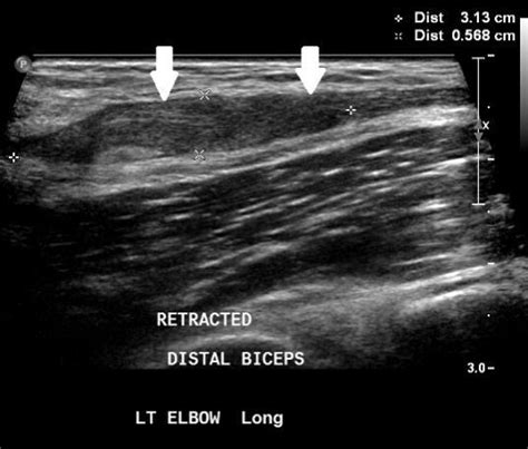 New Content Radiology Imaging In Acute Distal Biceps Ten Issuu