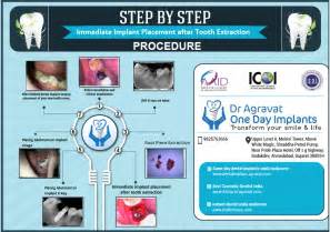 Immediate Implant Placement After Tooth Extraction Procedure And Reviews
