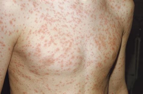 Measles Rash Symptoms Causes Treatment
