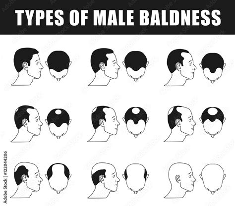 Male Baldness Type Baldness Head Baldness Norwood Scale Human