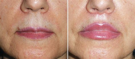 Before And After Mohs Surgery Upper Lip