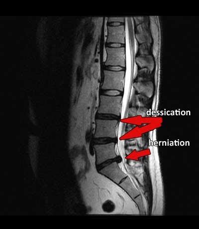 Always have pain some weeks are worse than others. L5-S1 Disc Herniation & Dessication - What is it?