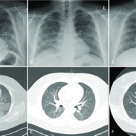 A D On Admission Chest Radiographs Showed Diffuse Opacities In Both