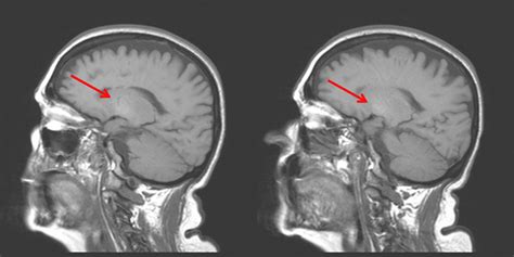 Hipoxia Cerebral Qué Es Síntomas Consecuencias Y Más
