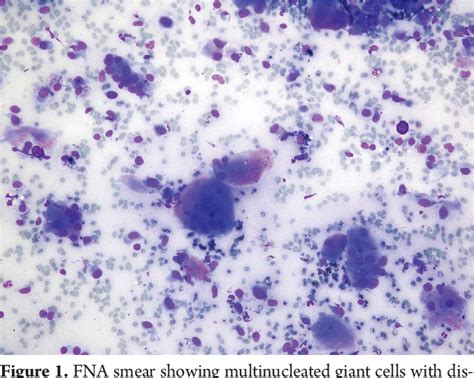 Figure 1 From Giant Cell Tumor Of Soft Tissues With Neurofibromatosis