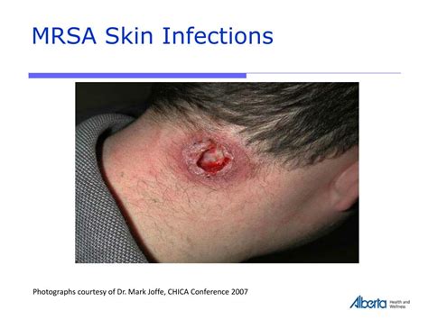 Ppt Provincial Mrsa Infection Prevention And Control Ipc Guidelines