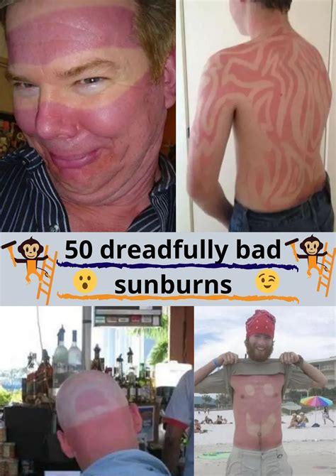 50 Dreadfully Bad Sunburns Where People Didnt Stand A Chance Against
