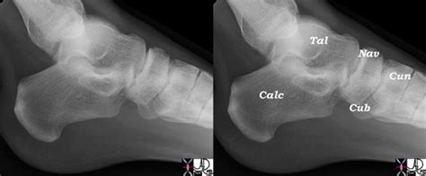 Calcaneus Bone Fractures