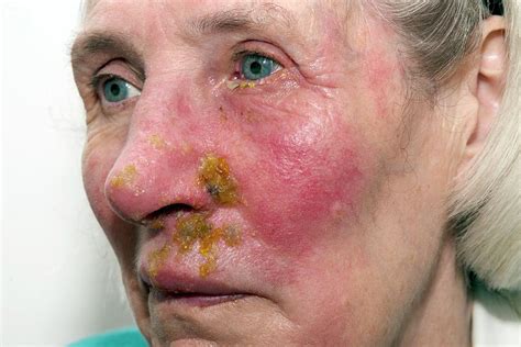 Shingles Rash On The Face Photograph By Dr P Marazziscience Photo Library