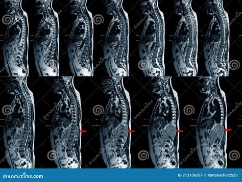 Mri Thoracic Spine Showing Tumor Or Mass In The Body Stock Image