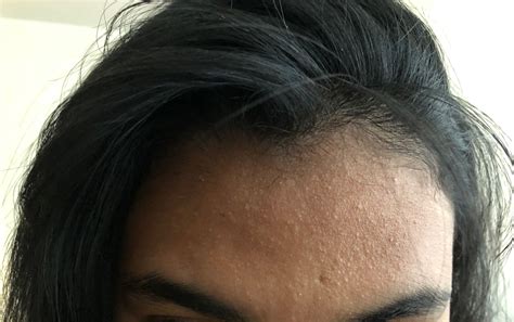 Forehead Bumps Beauty Insider Community