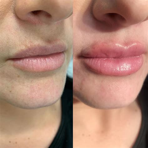 Top 92 Pictures Lip Filler Photos Before And After Full Hd 2k 4k