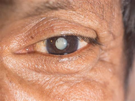 Tipos de Cataratas en los Ojos Conócelos todos Área Oftalmológica