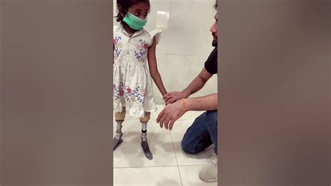 Younger Bilateral Above Knee Amputee Walk Prosthetic Leg Above Knee