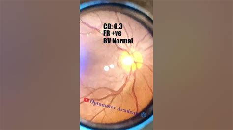 Smartphone Fundus Videography Fundus Photography Short Video 22