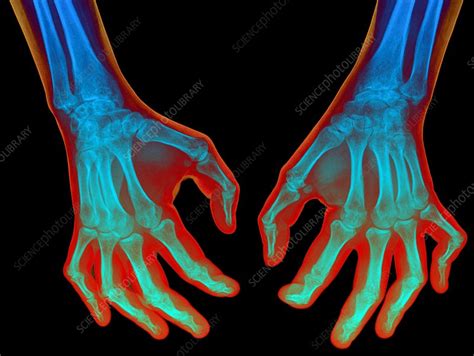 Arthritic Hands X Ray Stock Image C0215447 Science Photo Library
