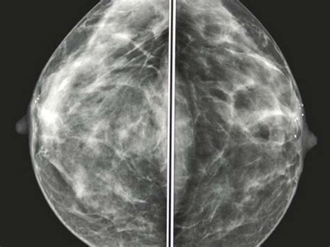 Mammogram Images Normal Abnormal And Breast Cancer Gambaran