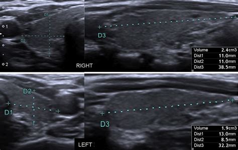 Normal Thyroid Ultrasound Colors