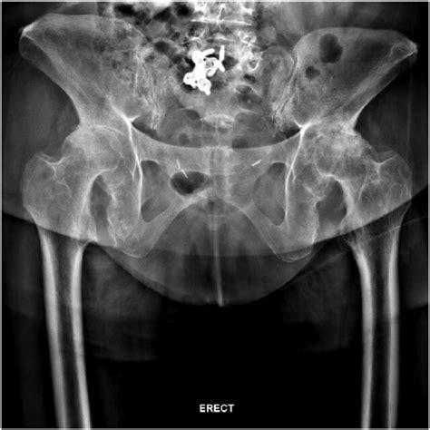 Anteroposterior Ap Pelvis Radiograph Demonstrating Bilateral Hip