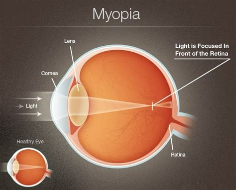 Myopia Nearsightedness Definition Symptoms Causes Treatment