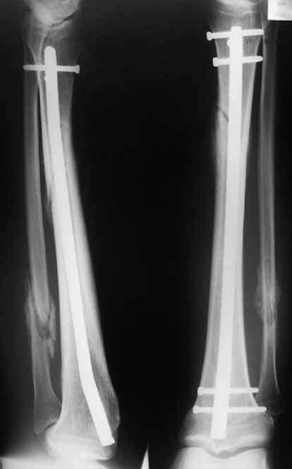 Spiral Fracture Tibia Xray Stress Fracture Of Tibia Radiology At St
