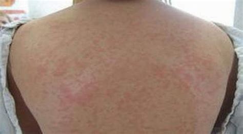 Hiv Rash Pictures Images Symptoms Causes And How Long Does It Last