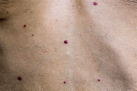 Red Moles Cherry Angiomas Sudden Signs To Look For
