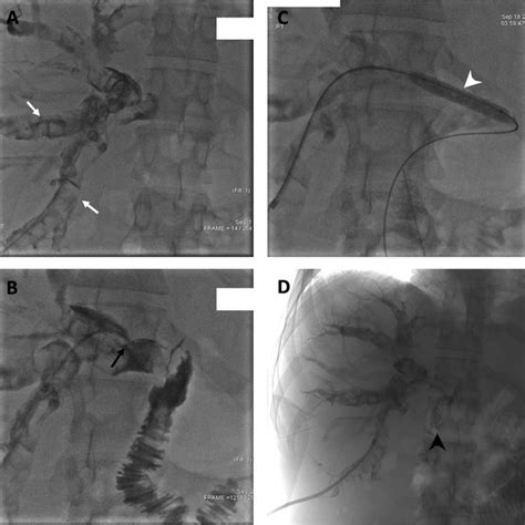 Cholangiogram Approximately 35 Months After Presentation A
