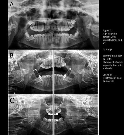 Mini Implant Based Uprighting Of Impacted Mandibular Second Molars A