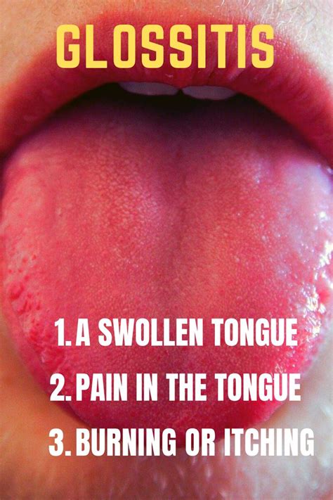 Tongue Tongue Disease Tongue Disorder Glossitis Swollen Tongue