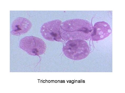 Trichomonas Discharge Infection