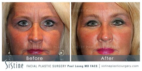 Nasolabial Folds Before And After 01 Sistine Facial Plastic Surgery