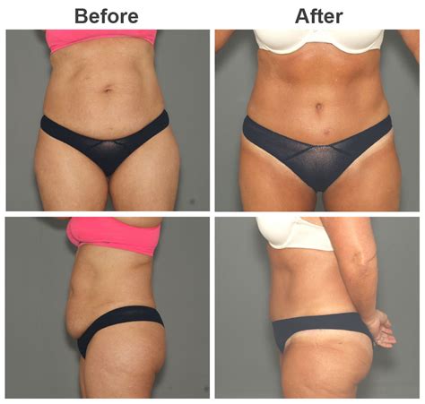 Atlanta Liposuction Surgeries Dr Vincent Zubowicz