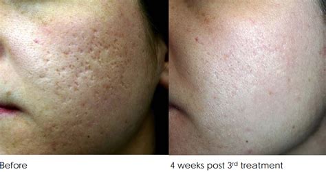 Acne Scar Removal Treatment Melbourne Before And After 3 Treatments