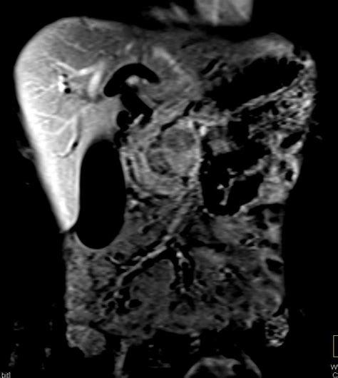 Pancreatic Cancer And Ipmm Body Mr Case Studies Ctisus Ct Scanning